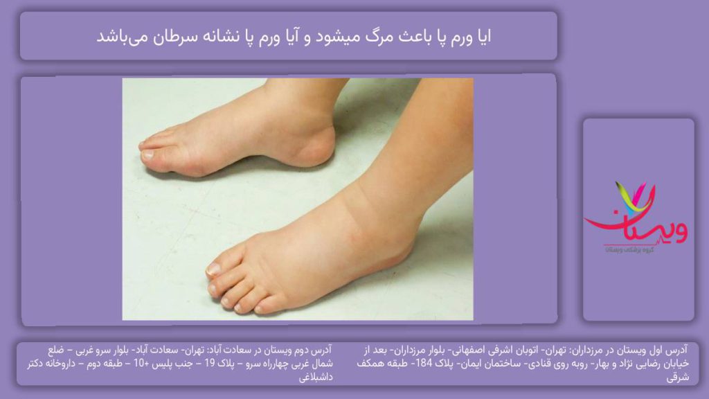 ایا ورم پا باعث مرگ میشود