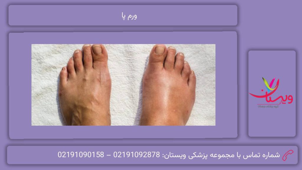 مهمترین علل ورم پا ورم پا