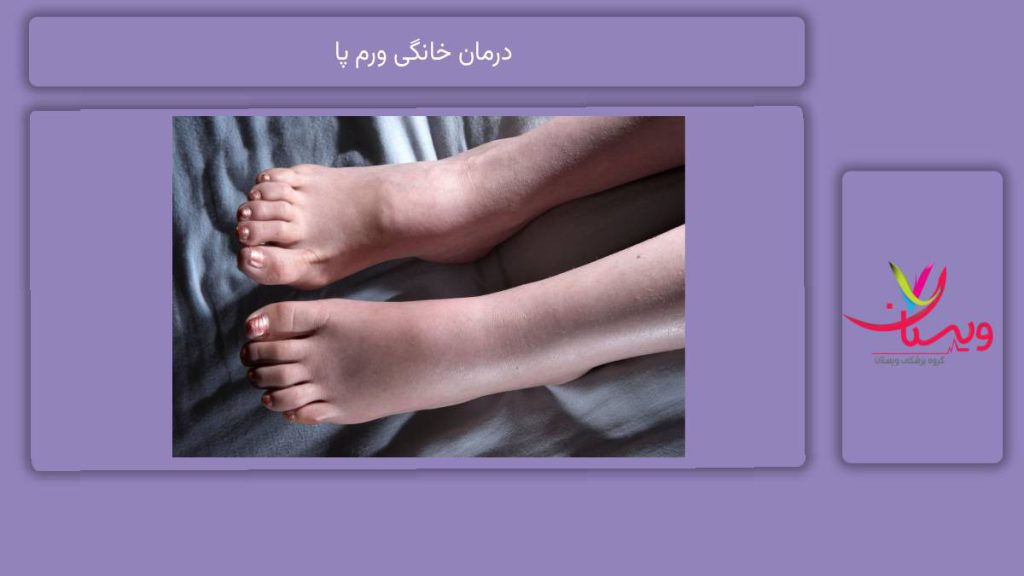 مؤثرترین روشهای درمان خانگی درمان خانگی ورم پا