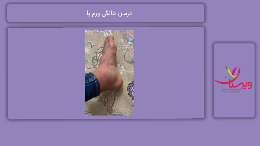 راههای علاج در منزل درمان خانگی ورم پا