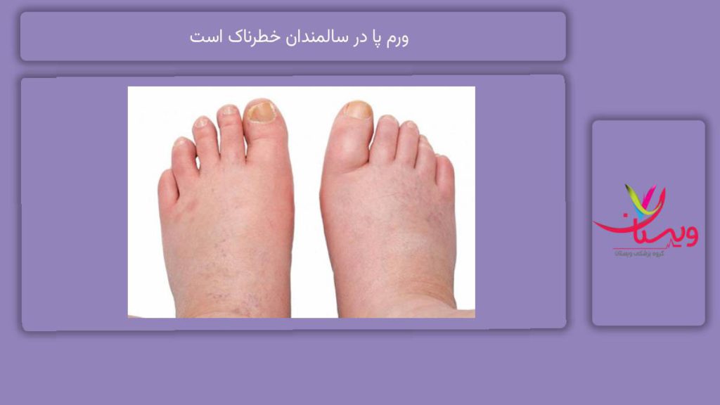 ورم پا در سالمندان خطرناک است
