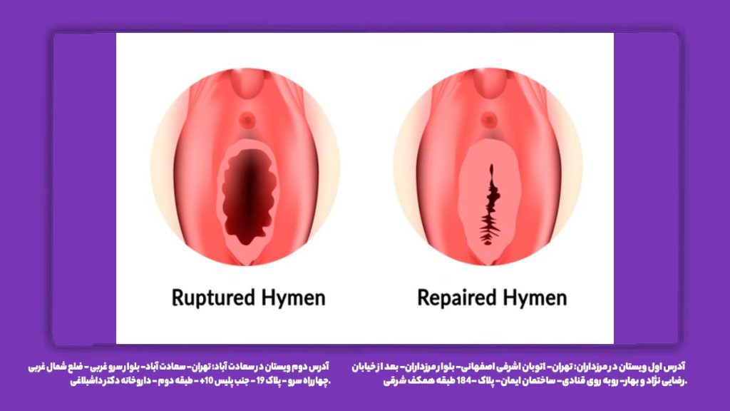 ترميم بكارت بدون عمل