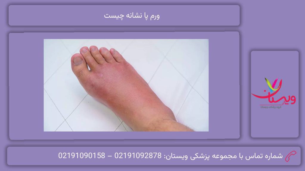 مهمترین دلایل این مریضی ورم پا نشانه چیست