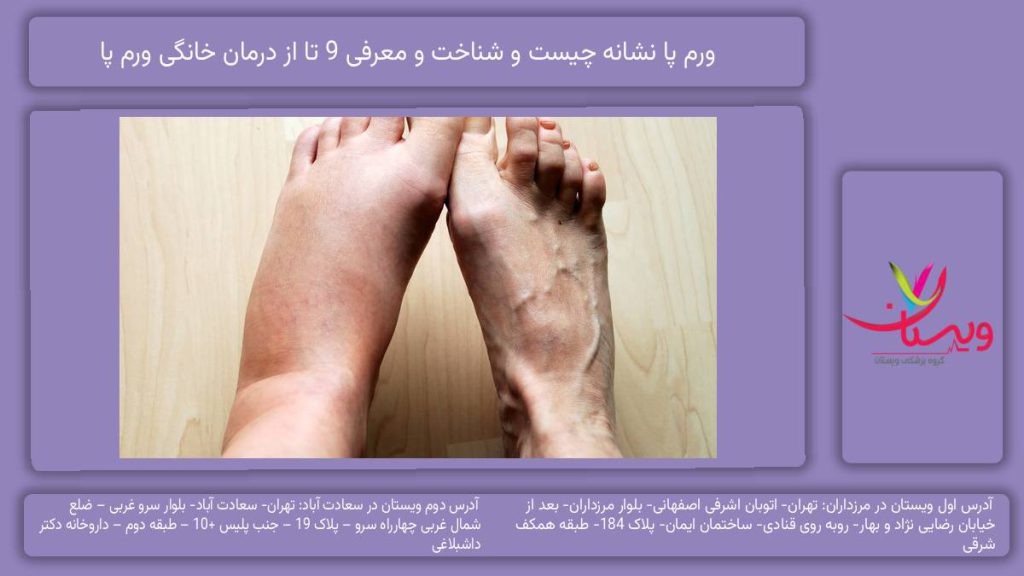 ورم پا نشانه چیست