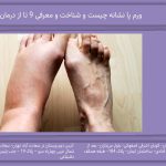 ورم پا نشانه چیست