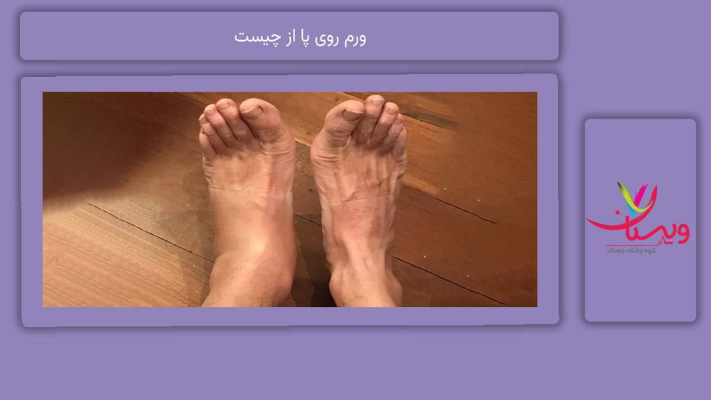 علائم همراه با این ورم ورم روی پا از چیست