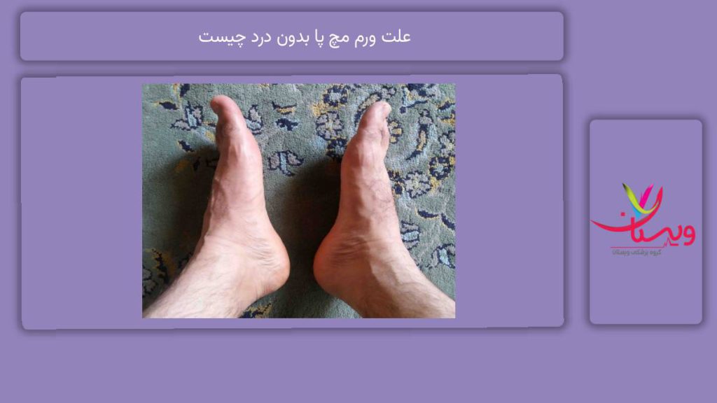 دلایل ورم مچ پا اما بدون درد علت ورم مچ پا بدون درد چیست
