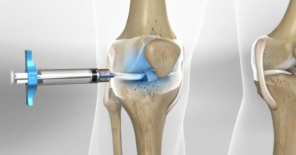 جدول مقایسه ی انواع روش جایگزین تعویض مفصل زانو جدول مقایسه ی انواع روش جایگزین تعویض مفصل زانو