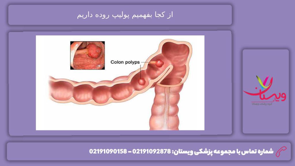 مواردی که احتمال پولیپ روده را افزایش میدهد از کجا بفهمیم پولیپ روده داریم