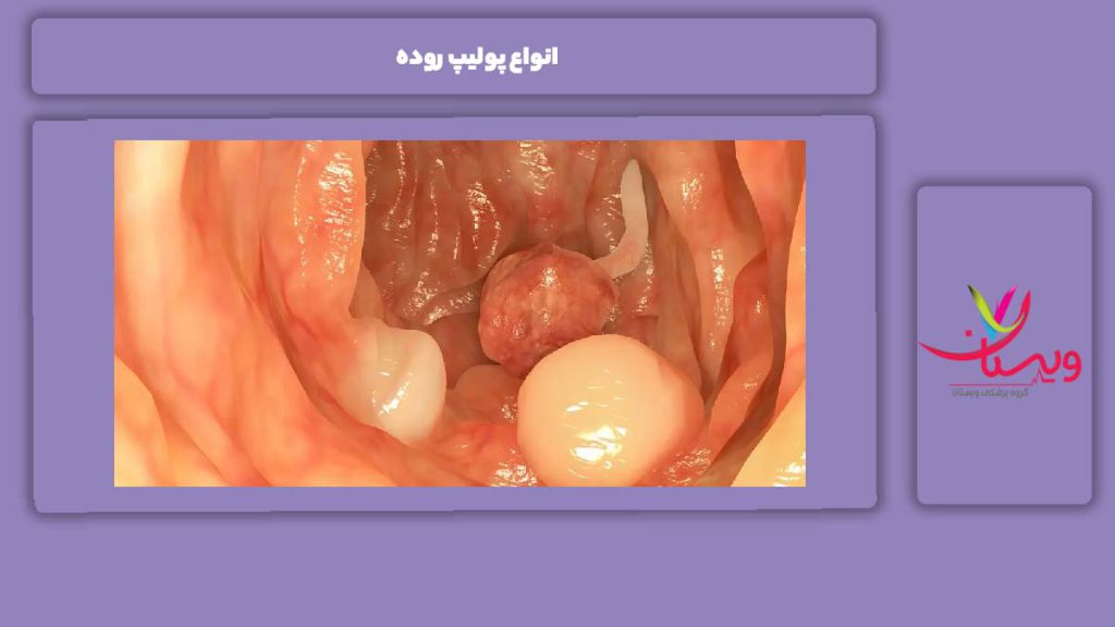 انواع شایع پولیپ روده علائم پولیپ روده خطرناک