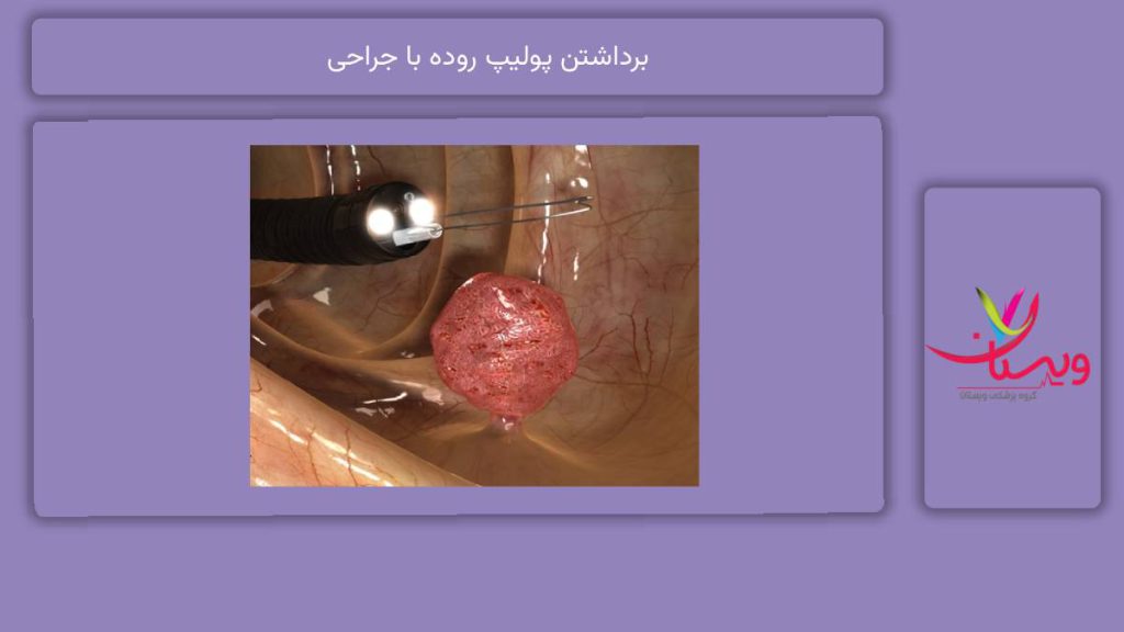 روشهای جراحی پولیپ روده برداشتن پولیپ روده با جراحی