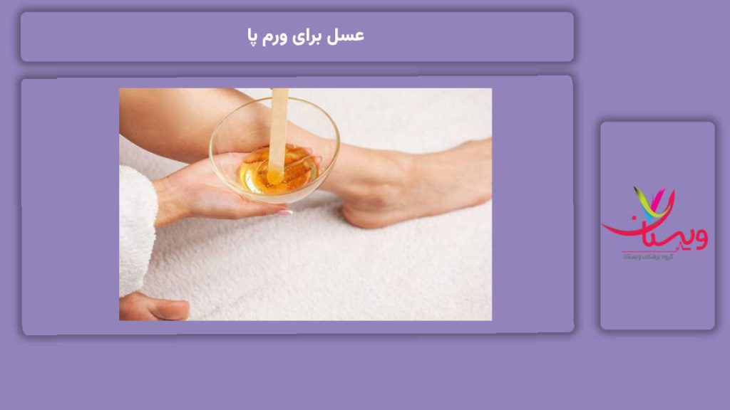 عسل برای ورم پا