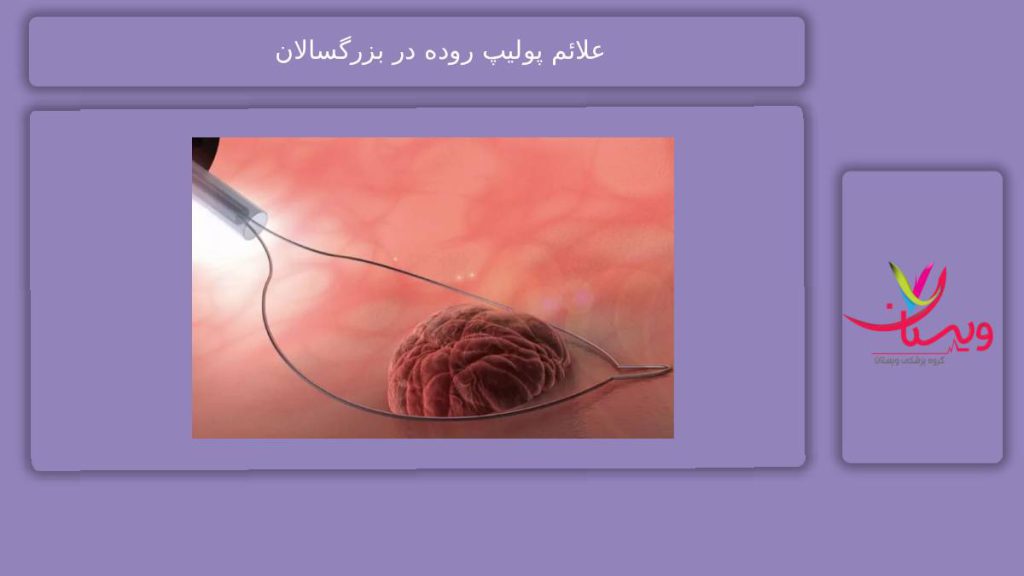 شایعترین علائم علائم پولیپ روده در بزرگسالان