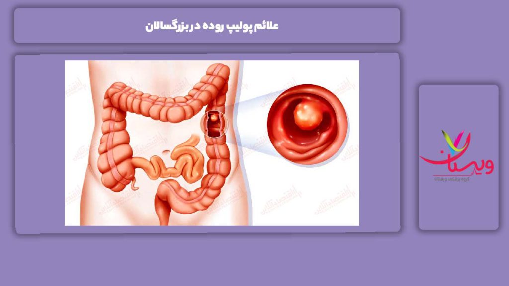 نکات مهم درباره علائم پولیپ روده در بزرگسالان علائم پولیپ روده در بزرگسالان