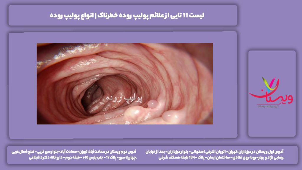 علائم پولیپ روده خطرناک