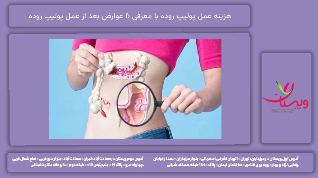 هزینه عمل پولیپ روده